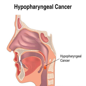 Hypopharynx cancers